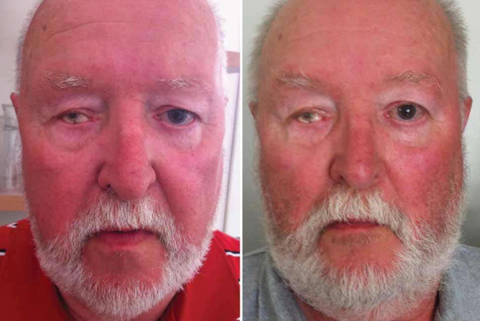 male client with beard before and after photo facial rejuvenation miskin organics