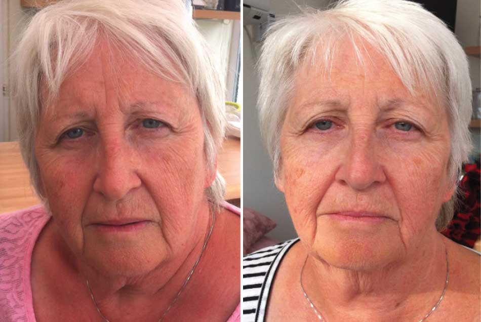 60 something female client before and after photo facial rejuvenation miskin organics