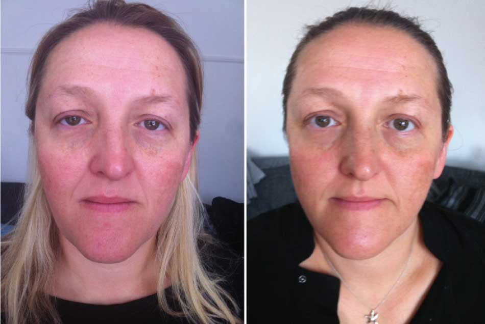 female client before and after photo facial rejuvenation miskin organics